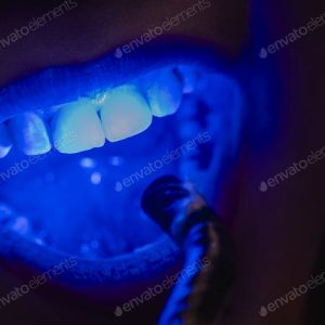 Teeth whitening procedure with blue light activation.